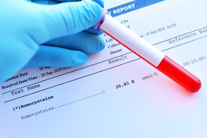laboratory-result-of-homocysteine-test-to-test-for-vitamin-b12-deficiency