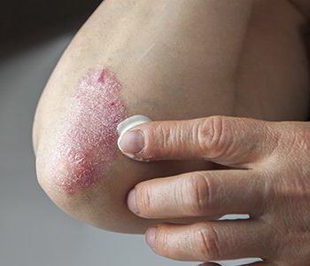 psoriasis