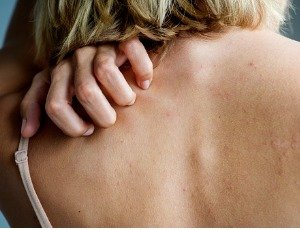 woman with itchy skin scratching her back